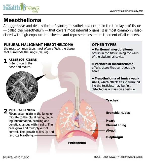 Mesothelioma Infographic - Symptoms and Asbestos Cancer Treatment